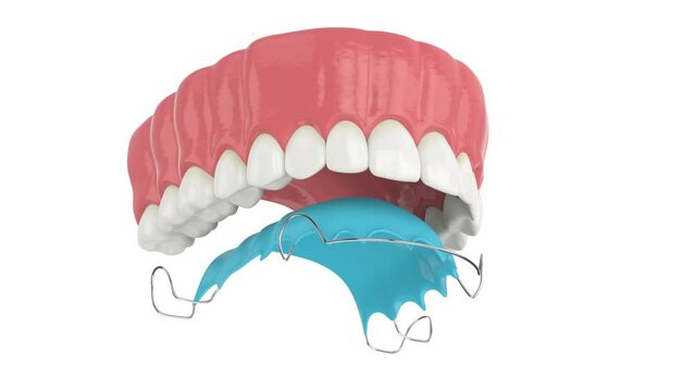 Upper jaw with orthodontic removable retainer