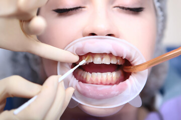 Professional teeth cleaning. The doctor applies a protective gel to the teeth. Caries prevention. A...