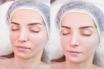 
The result of cosmetic procedures before and after. Cosmetology, salon, personal care.