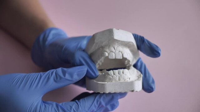 Plaster cast of the upper and lower jaw in the hands of an orthodontist. The dentist points out a dental problem on the upper jaw plaster cast. Close-up