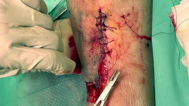 Réalisation d'un point de suture à l'hôpital 