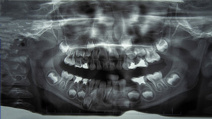 Panoramic x-ray of a child's upper and lower jaw teeth with damaged milk teeth and intact future permanent wisdom teeth