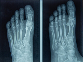 Foot and Toes. Human Leg in the X-ray image