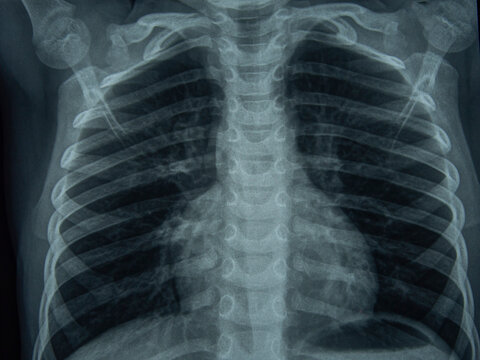 Radiographic image or X-Ray Image of Human Chest for a medical diagnosis . check up concept