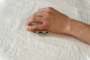 Fixateur externe nach einer OP am kleinen Finger der linken Hand nach einem komplizierten Bruch der...