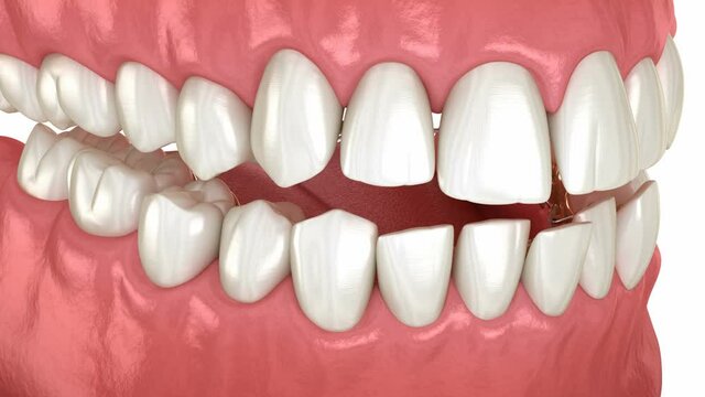 Lingual braces system, bite correction. 3D animation concept of golden braces