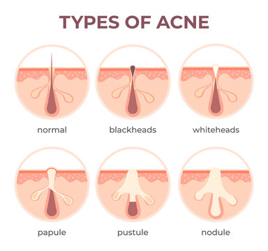 Acne Types Anatomy. Pimple Diseases Sectional View Blackhead, Cystic And Whitehead. Structure Of Skin And Pore Infection Vector Infographic