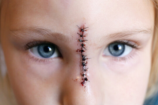 Young Child with Sutures on Face from Injury