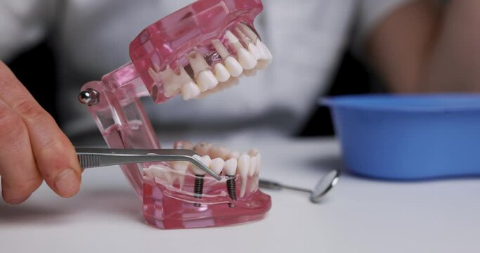 dentist implantologist showing dental bridge implant technology on human tooth jaw model. closeup