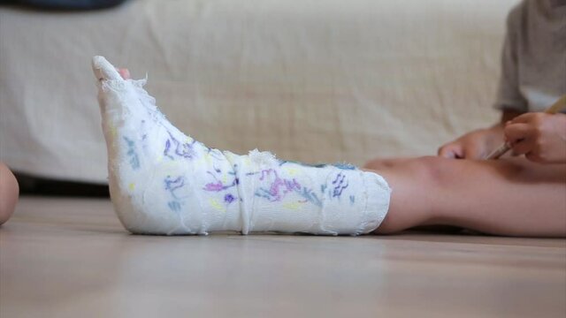 broken leg. damage to the bones. a child paints a plaster. a girl with a marker