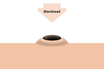 Blackhead, Open comedone, Skin acne problems, Inflamed acne