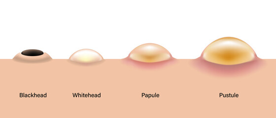 Type of acne diagram, Skin acne on side view, Blackhead, Whitehead, Papule, Pustule, Skin problems