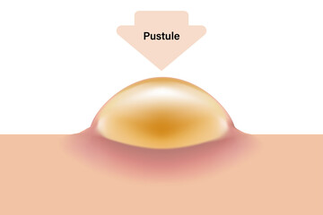 Pustule, Skin acne problems, Inflamed acne