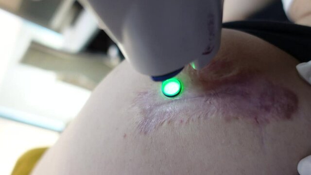 Flatten Keloids scar treatment with vbeam laser therapy and corticosteroid injection shots cosmetic patient in motion