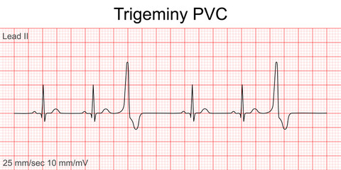 Electrocardiogram show ventricular fibrillation (VF) pattern. Cardiac fibrillation. Heart beat. CPR. ECG. EKG. Vita