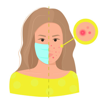 Maskne Concept. Acne Caused Wearing Face Mask Due To Coronovirus Pandemic. Flat Female Character Portrait Struggling With Pimples. Acne Closeup.  Isolated Vector