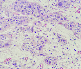 Photo of high-grade infiltrating urothelial carcinoma, magnification 400x, photo under microscope