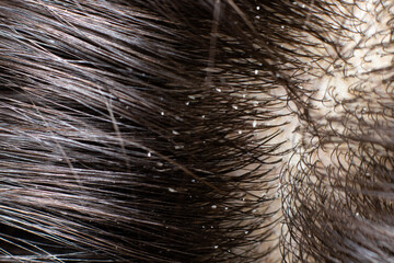 Macro photo dander on dark brunette hair. The problem of dried scalp, wrong shampoo, fungus on the head