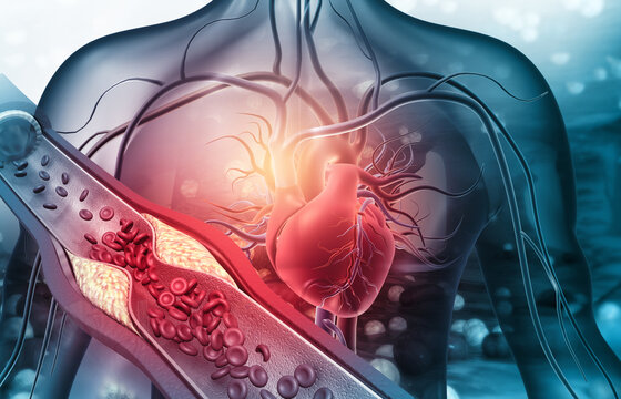 Human heart with blocked arteries. 3d illustration.