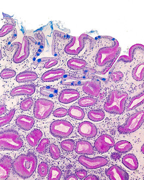 Intestinal Metaplasia Of Gastric Mucosa