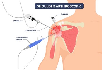 Shoulder Arthroscopy tear cuff repair treat problem joint pain injury disease disorder painful heavy lifting damage tendons Bankart SLAP