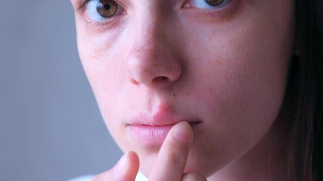 Herpes virus on human lips. Woman with herpes sore on upper lip on mouth, face closeup. Herpes Simplex Virus. Process of dehydration during illness. Human papilloma virus, viral infection.