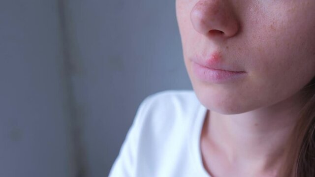 Herpes virus on human lips. Woman with herpes sore on lip mouth, closeup view. Process of dehydration during illness. Human papilloma virus, viral infection.