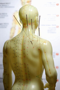 male acupuncture model with needles in the right shoulder
