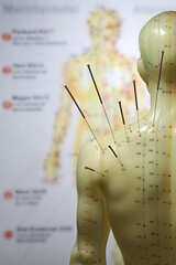 male acupuncture model with needles in the left shoulder - obrazy, fototapety, plakaty