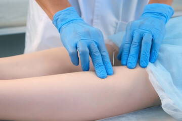 Man doctor acupuncturist in gloves is inserting acupuncture needle to woman's legs. Woman patient is lying on couch in hospital, closeup view. Chinese medicine alternative in European world.