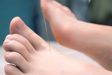 Man doctor acupuncturist in gloves inserts acupuncture needle to woman's feet. Woman patient is...