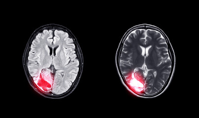 Compare MRI brain  Axial T2W flair and T2W view  for showing enchepalomalacia disease.