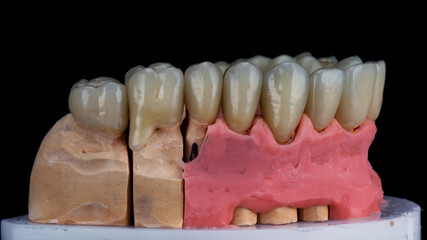 set of ceramic crowns and veneers of the upper jaw side view of the chewing teeth © Dental Pro Content