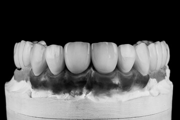 dental veneers made of ceramic of the upper jaw on a plaster model, photo in black and white style © Dental Pro Content