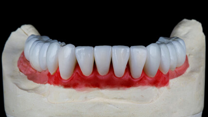 dental veneers made of ceramic of the lower jaw on a plaster model with red gums