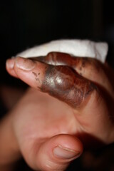 Fototapeta premium burned fingers with big blisters