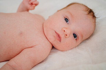 A baby with seborrheic dermatitis on his head rests on a white sheet. childcare.