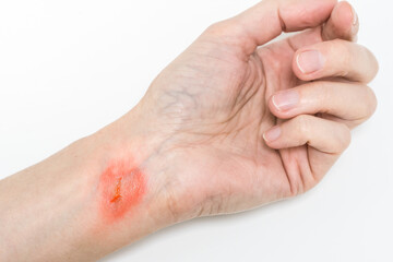Burn of a skin on woman’s hand isolated on white,  burst blister on female hand  injured with  boiling water, careless behavior wit boiling water and steams 