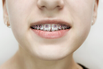 Naklejka premium Dental braces with pink rubber bands on a young girl's teeth, close up
