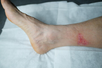 large healing wound from a severe burn on the leg of an adult male patient, redness, scarring of the skin, the concept of medical care, human tissue regeneration