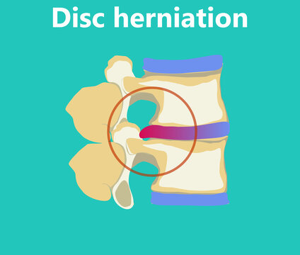 An intervertebral disc herniation flat illustration. Inflamed disc causing pain and discomfort. Degenerative process in spine. Educational medical information.