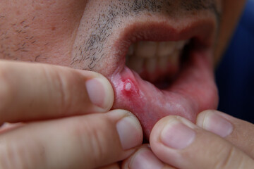 man has aphthous ulcers in the mouth, selective focus