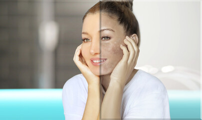 Dark spots, freckles,hyperpigmentation(melasma or chloasma),concept - skin lightening, skin...