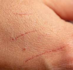 Scratches from the claws of a cat on human skin.