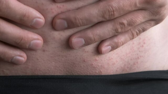 Man is scratching small spots rash on his abdomen by hands, closeup view. Part of body in black pants. The concept of venereal diseases. Allergies, psoriasis, insect bite. Itchy skin irritation.