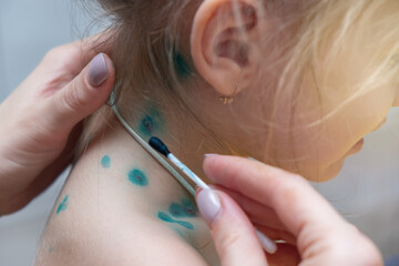 Doctor examining and treats acne with brilliant green a child covered with green rashes on stomach ill with chickenpox, measles or rubella virus.