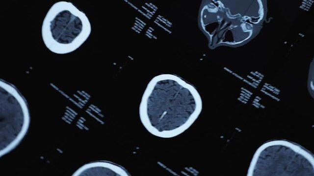Magnetic resonance imaging of an older man's brain after a traumatic brain injury, which shows that the brain is damaged. Tomographic image of the head