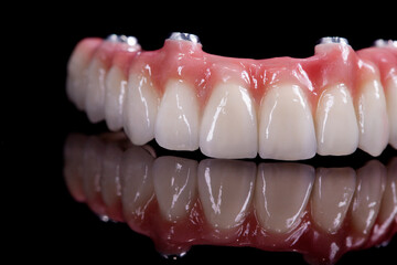 Beautiful upper teeth ceramic press ceramic crowns and veneers on the dental stone model zircon arch ceramic prothesis Implants . Dental restoration treatment clinic patient. oral surgery dentist
