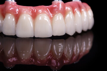 Beautiful upper teeth ceramic press ceramic crowns and veneers on the dental stone model zircon arch ceramic prothesis Implants . Dental restoration treatment clinic patient. oral surgery dentist
