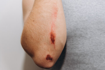 Large abrasions on the forearm of a man after a fall.